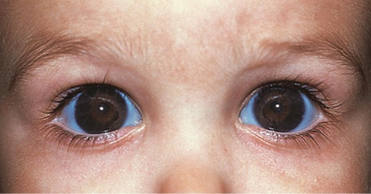 Parent’s Guide to Treating Pediatric Glaucoma